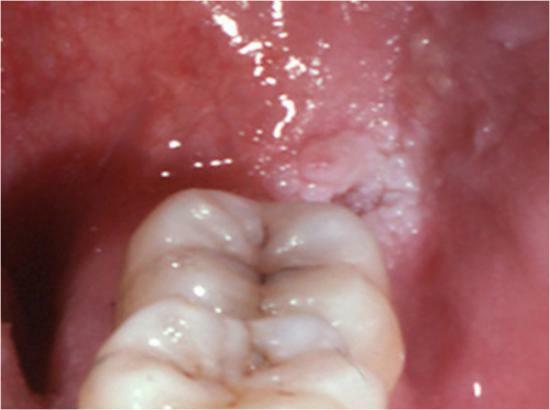 Peludas causas del lenguaje leucoplasia de la enfermedad, síntomas, tratamientos