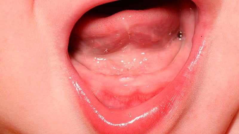 Eruption af de øverste tænder hos børn: foto, symptomer