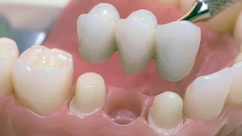 Muovi hammasproteesit: hyvät ja huonot puolet, kustannukset
