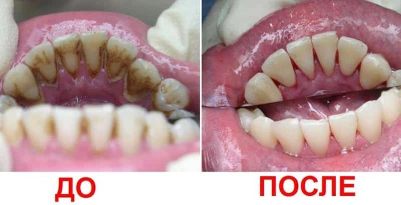 los dientes de limpieza por ultrasonido