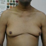 Mäns bröstplastikkirurgi