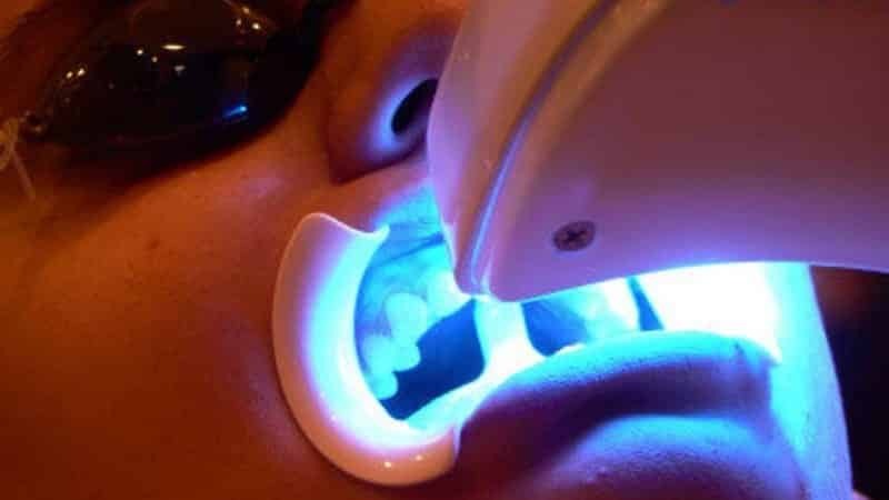 eine Zahn der sichersten und effektive Whitening
