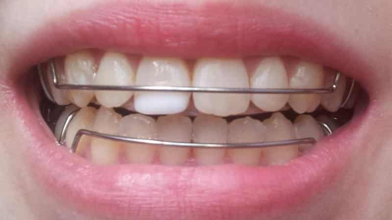 Platten für die Ausrichtung der Zähne bei Kindern und Erwachsenen