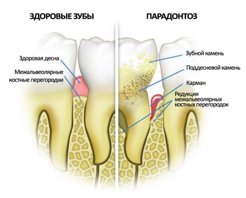 Foto antes y después de la periodontitis