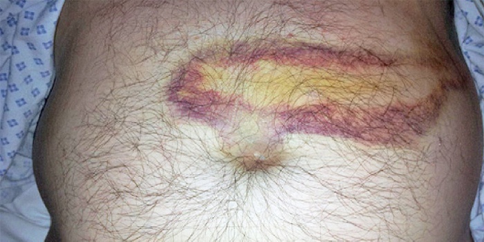 The appearance of spots on the skin with diseases of the pancreas