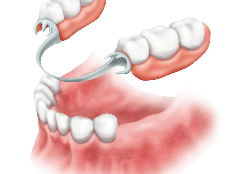 Features of prosthetics of teeth: types of products, which prosthesis is better to buy, reviews