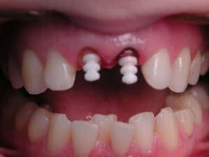 Kontraindikace kapacity zubů