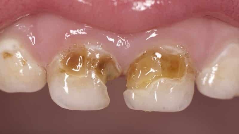 dientes de la fluoración lo que es