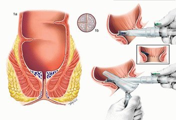 Hemoroidi po odstranitvi operacije: pooperativno obdobje in okrevanje