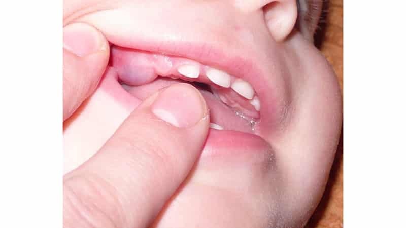 Cómo dentición en los niños