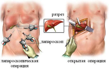 Laparoscopia y cirugía abierta
