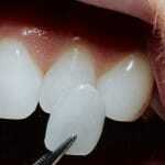 Metoder för riktning tänder