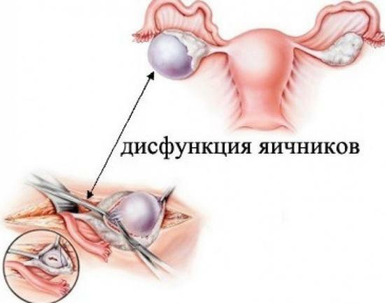 disfunzione ovarica, il trattamento di rimedi popolari, preventiva