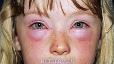 Allergische Konjunktivitis bei Kindern