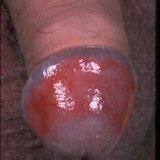 Giliųjų varpos odos uždegimas - balanitas