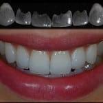 Wie schiefe Zähne erwachsen beheben