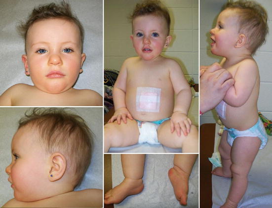 Prader-Willijev sindrom pri otrocih: kaj je to, simptomi, fotografije, zdravljenje