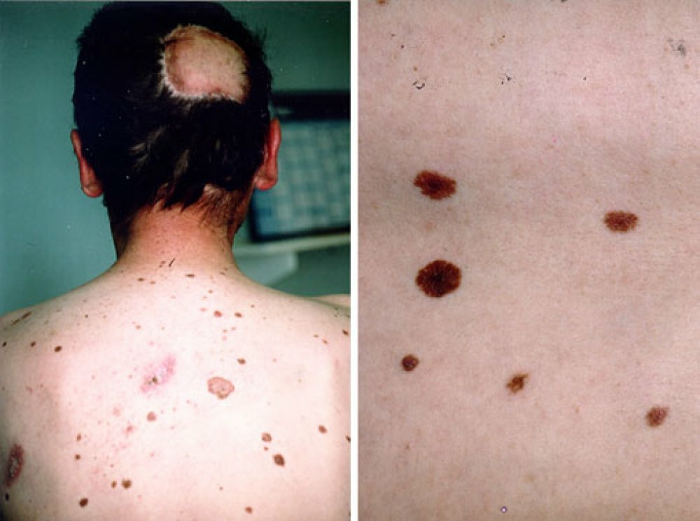 NEVI: osnovne vrste, načela diagnozo, preprečevanje melanoma