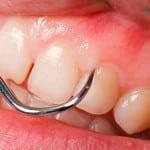 Årsagerne til tandkødssygdomme