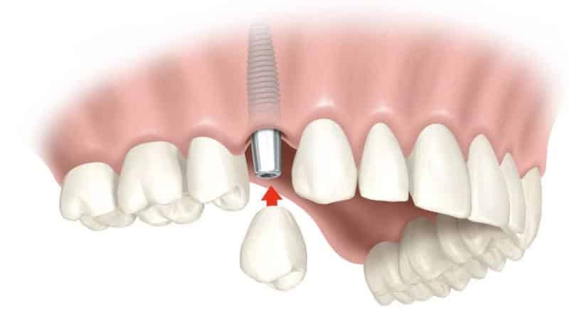 Po nějakou dobu po odstranění zubů protézy může být