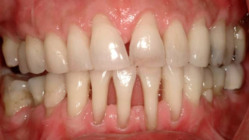 cómo tratar la enfermedad periodontal en el hogar