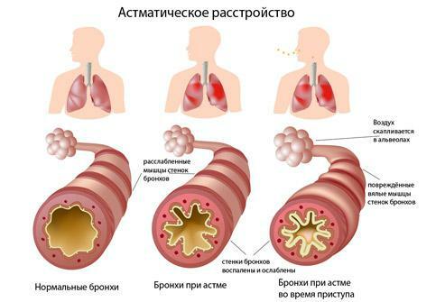 Husten Asthma