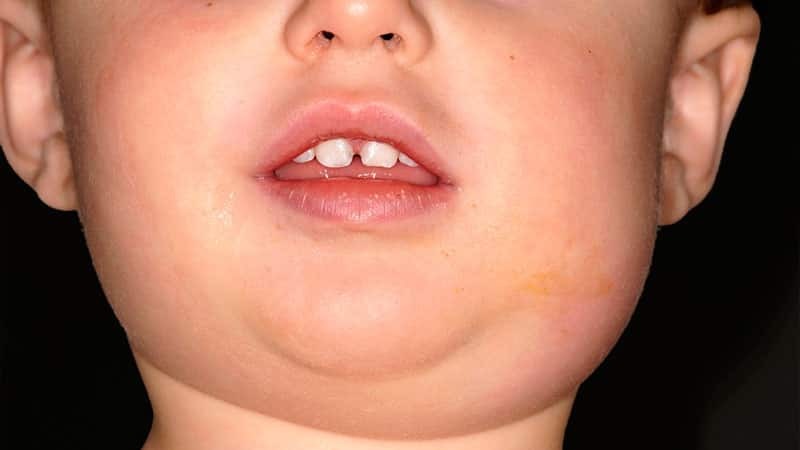 Inflammation of the child