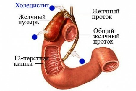 Colecistitis de la vesícula biliar