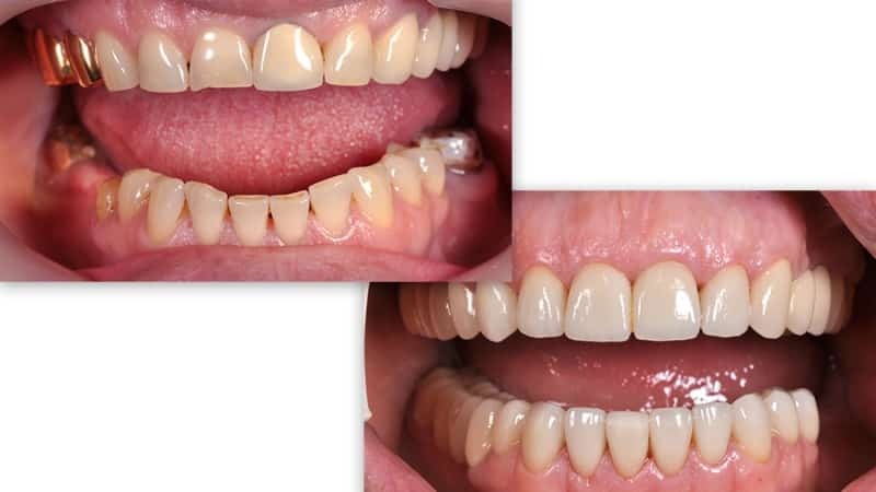 coroas metalo-cerâmicas sobre os dentes da frente de uma foto antes e depois
