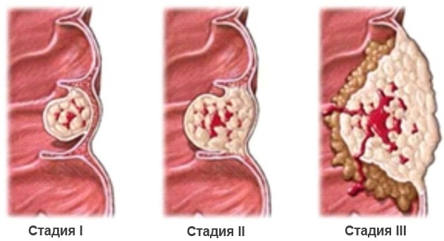 Aké sú príznaky nádoru hrubého čreva?