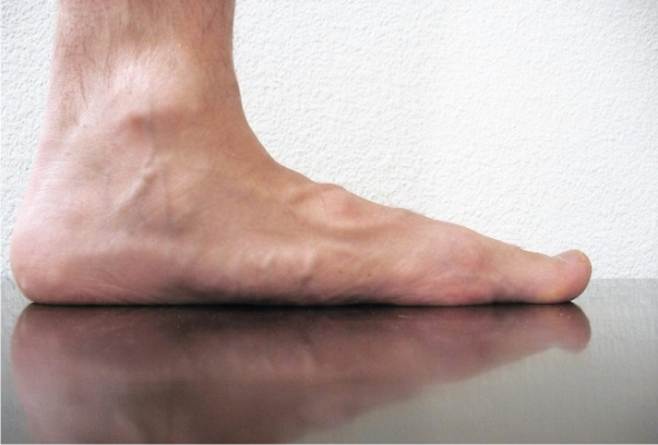 Flade fødder er en indikation for operation