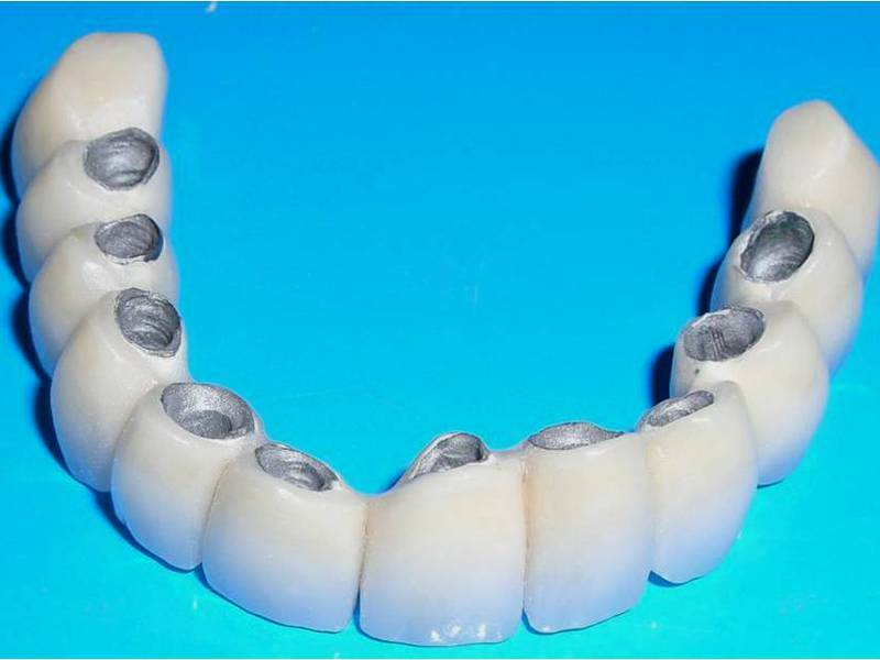 Diferentes tipos de dentes falsos - escolher a melhor maneira de resolver o delicado problema das diferenças de métodos e materiais