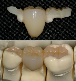 Restaurācija zobu izmantojot līmi tiltiem: priekšrocības, trūkumi un kontrindikācijām metode