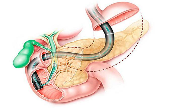 Diagnostics of pathologies of the pancreas (endoscopy)
