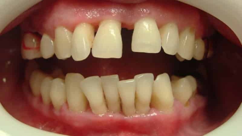 cura para la enfermedad periodontal