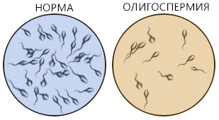 oligospermia