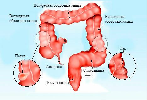 Struktur anatomi, penyakit dan pengobatan kolon sigmoid