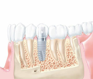 Głównymi wskazaniami do budowy tkanki kostnej w implantów dentystycznych