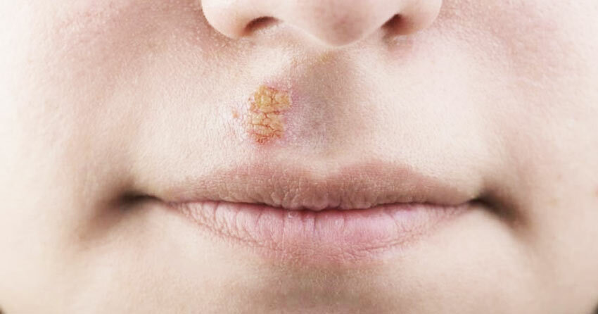 Behandling af herpes på læben