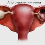 Apoplexy-ovary