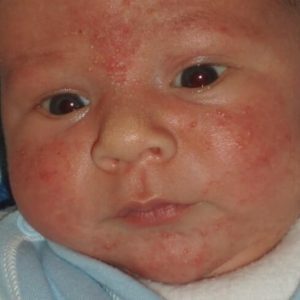 Allergi-at-bryst-mælk-på-babyer