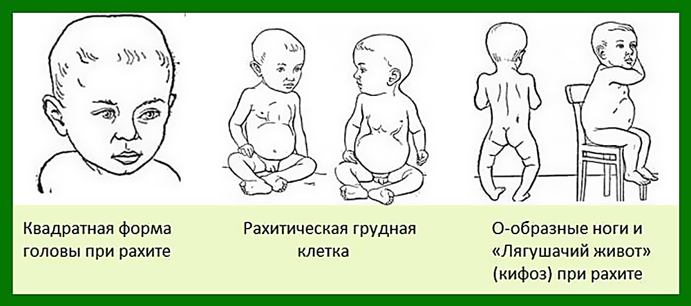 Rahitis pri otrocih: simptomi, zdravljenje in preprečevanje