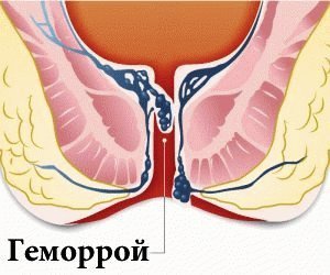 Hemoroidi: vrste, fotografije, simptomi, popoln opis