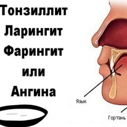 Causes of sore throat when swallowing