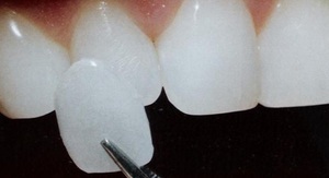 ultranirov przeciwieństwie Lumineers i oklein: cena 1 ząb