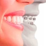 La alineación de los dientes en los adultos