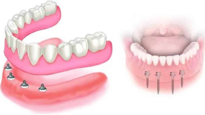 tipos de prós e contras próteses na ausência de dentes