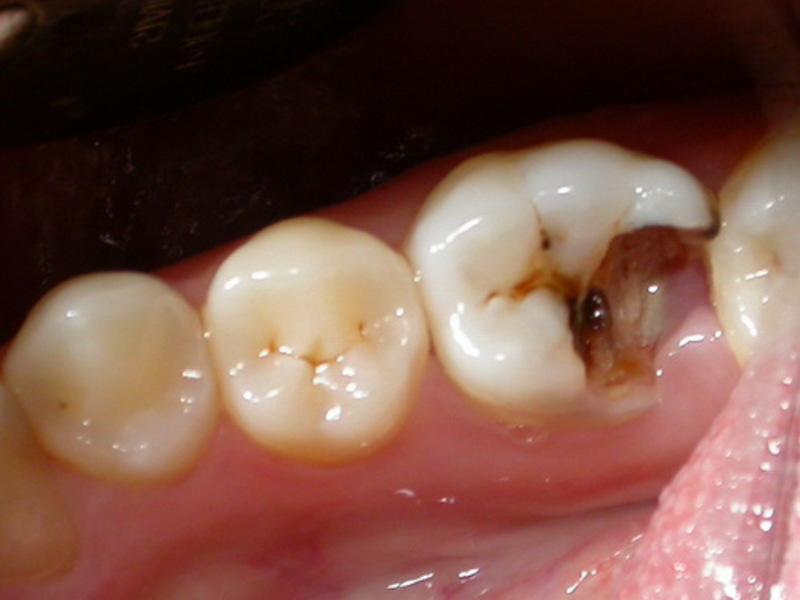 Извођења зуби цапацити