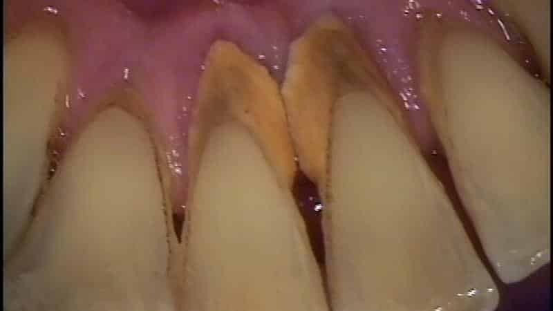 Erweiterte Formen der Parodontitis