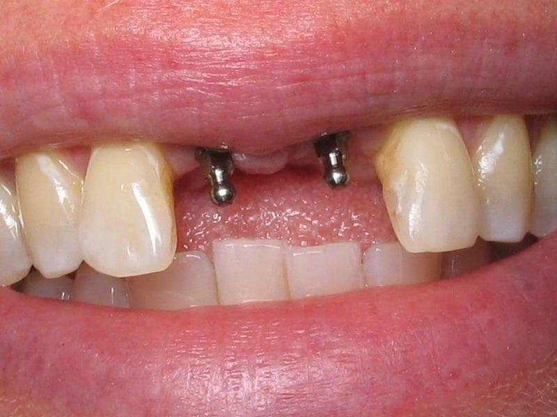 Tannimplantater: et bilde før og etter installering
